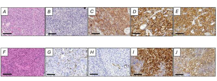 具有临床益处的脑膜瘤代表性组织学分析(A-E组)及无益病例(F-J组)。H&E染色(A，B)，免疫染色用于ki67(B，G)、p16(C，H)、周期蛋白D(D，I)和CDK4(E，J)。尺寸条 = 100微米。