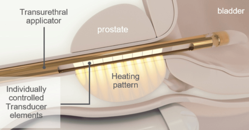 TULSA-PRO系统能够治疗体积较大或较小的前列腺病变，以及前列腺前部和后部组织。