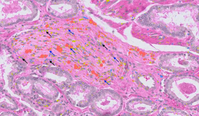 Cellular atlas of prostate cancer opens new avenues for earlier detection