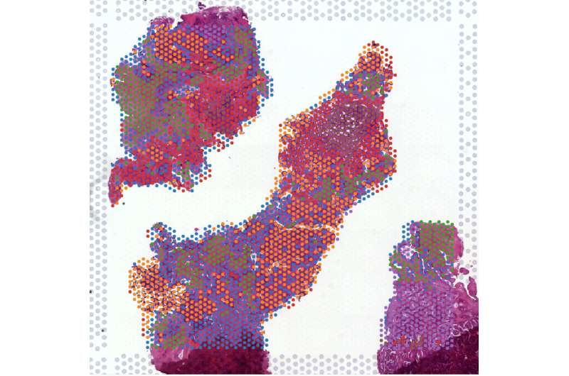 Cellular atlas of prostate cancer opens new avenues for earlier detection