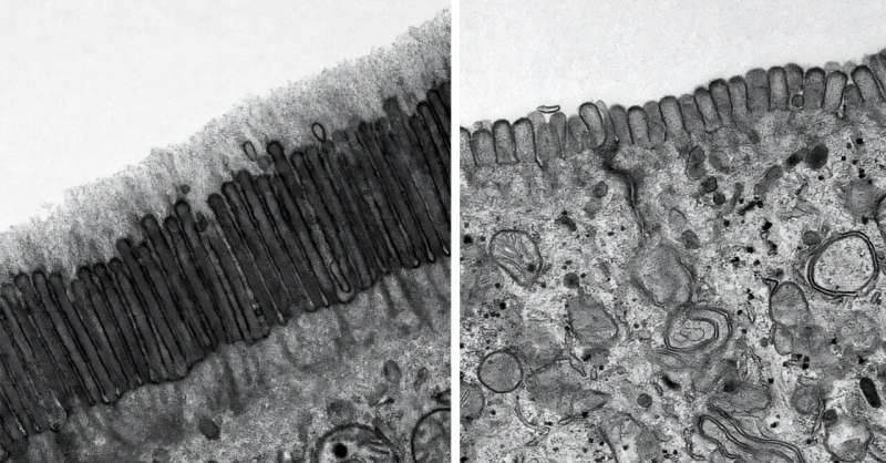 سبب أم نتيجة؟ دراسة تجيب على سؤال حول الجين المرتبط بسرطان القولون والمستقيم